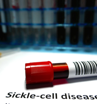 Sickle Cell Disease